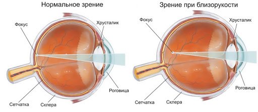 Близорукость.jpg
