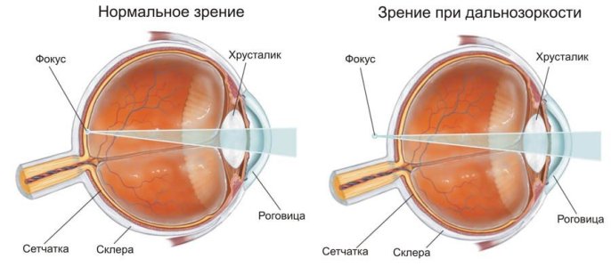 Дальнозоркость.jpg