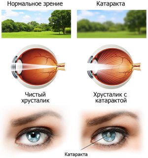 Катаракта.jpg
