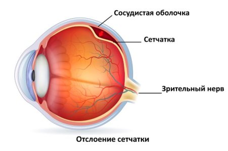 Отслойка сетчатки глаза.jpg