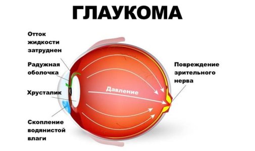 глаукома.jpg