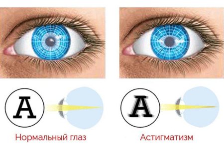 Астигматизм.jpg