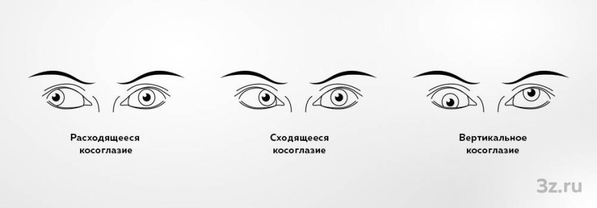 Косоглазие.jpg