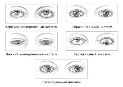 Нистагм.jpg