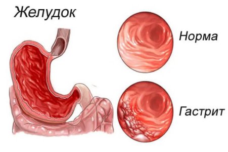 Гастрит.jpg