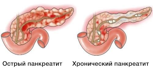 Панкреатит.jpg