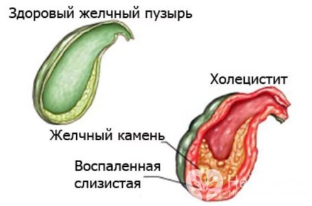 Холецистит.jpg