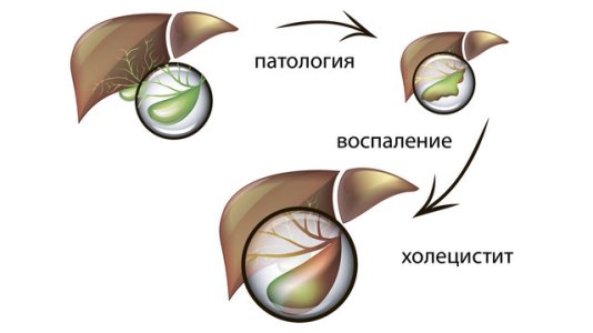 Холецистит.jpg