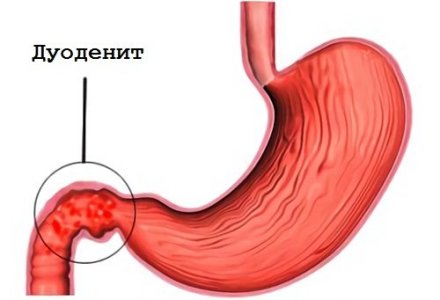 Дуоденит.jpg