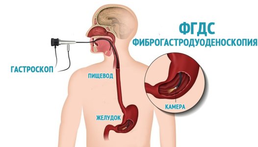 Фиброгастродуоденоскопия (ФГДС).jpg