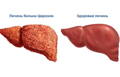 Цирроз печени.jpg