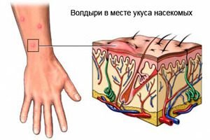 Инсектная аллергия.jpg