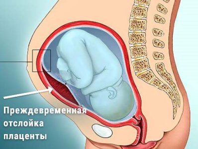 Преждевременная отслойка плаценты.jpg