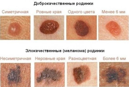 Родинки.jpg