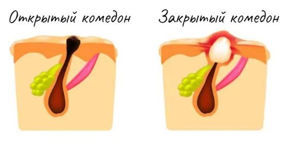 Комедоны.jpg