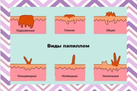 Папилломы.jpg