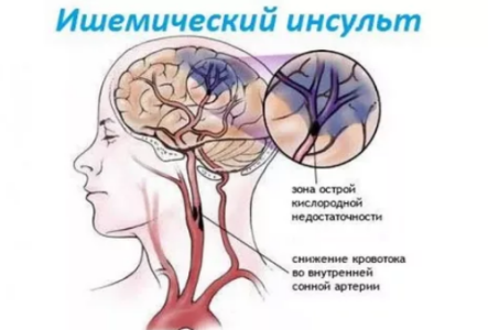 Ишемический инсульт.png