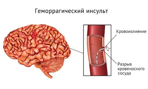Геморрагический инсульт.jpg
