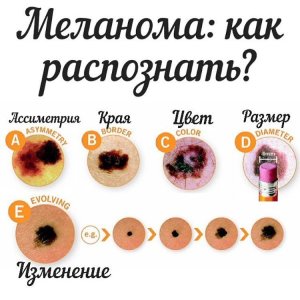 Меланома кожи.jpg