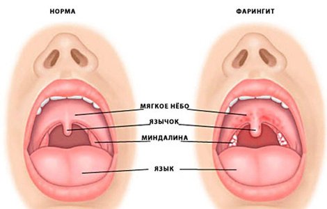 Фарингит.jpg