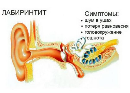 Лабиринтит.jpg