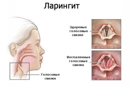 ларингит.jpg
