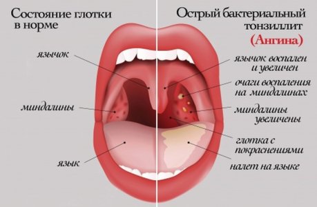 Ангина.jpg