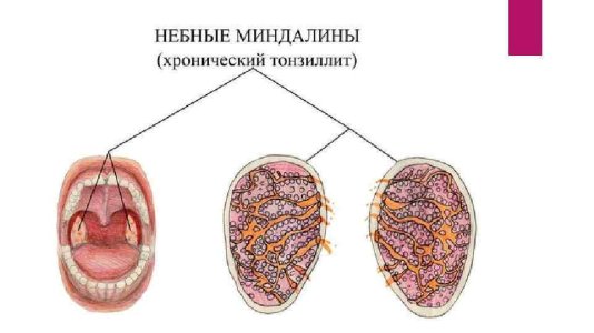 Хронический тонзиллит.jpg