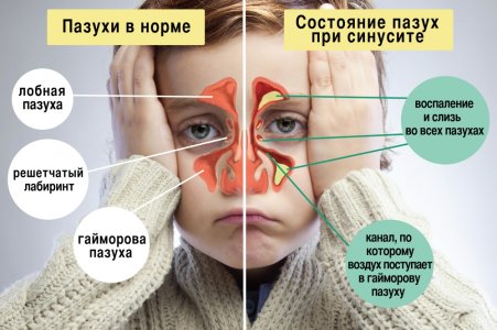 Синусит.jpg