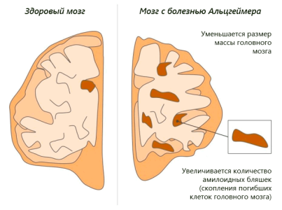 Болезнь Альцгеймера.png