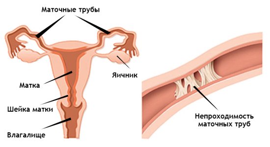 Гидросальпинкс.jpg