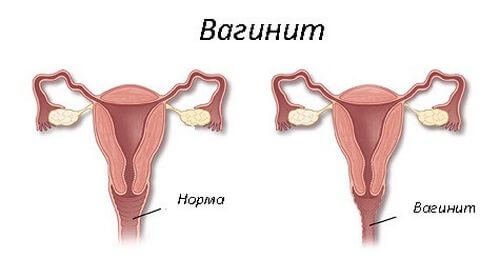 Вагинит.jpg
