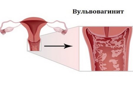 Вульвовагинит.jpg