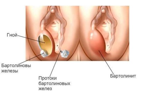 Бартолинит.jpg