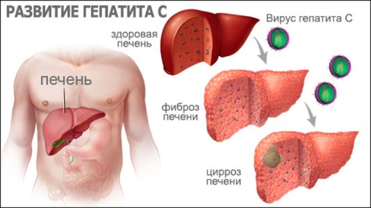 Гепатит C.jpg