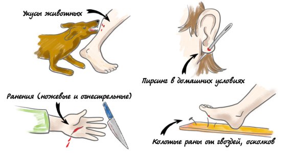 Столбняк.jpg