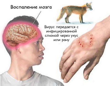 Бешенство у человека.jpg