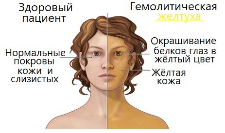 Гемолитическая желтуха.jpg