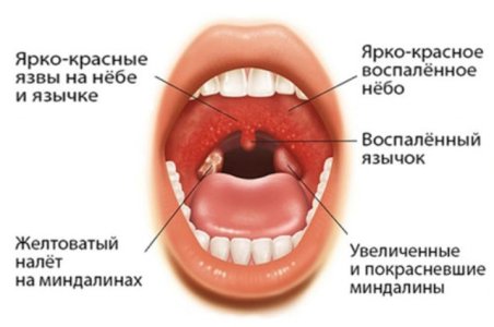 Инфекционный мононуклеоз.jpg