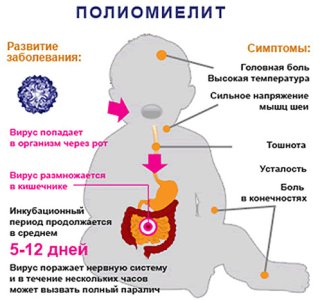 Полиомиелит.jpg