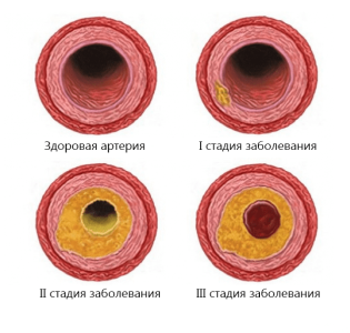 Атеросклероз.png