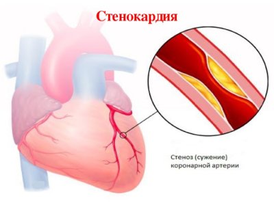 Стенокардия.jpg