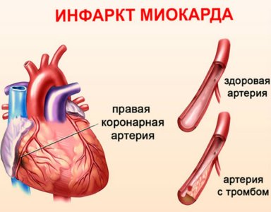 Инфаркт миокарда.jpg