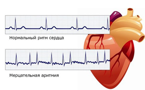Аритмия.png