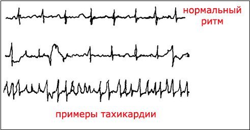 Тахикардия.jpg