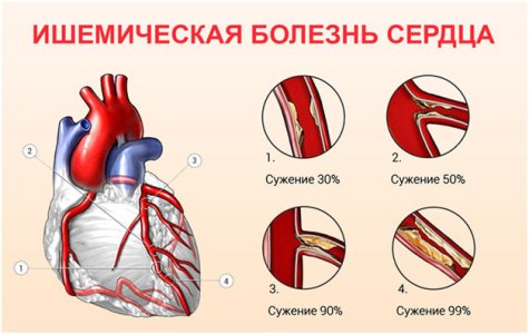 Ишемическая болезнь сердца.jpg