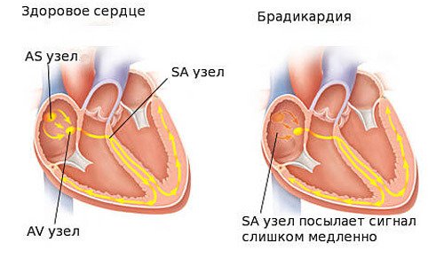 Брадикардия.jpg