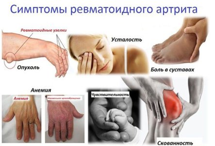 Ревматоидный артрит.jpg