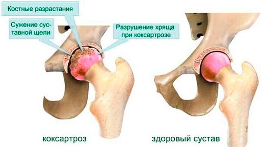 Остеоартроз тазобедренного сустава.jpg