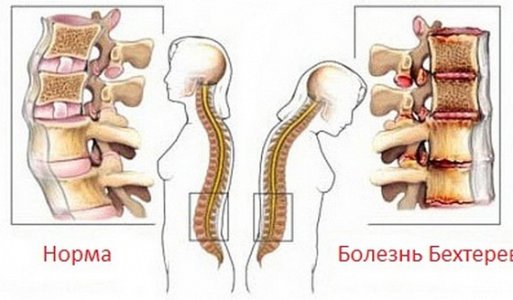 Болезнь Бехтерева.jpg